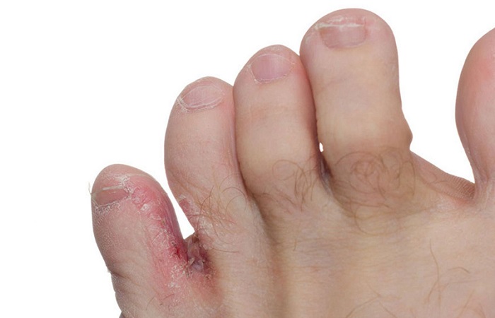 có đến 70% người mắc phải nấm da chân ít nhất 1 lần trong đời.