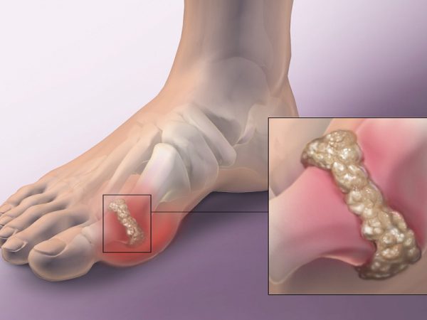 Bệnh Gout ảnh hưởng đến ngón chân cái